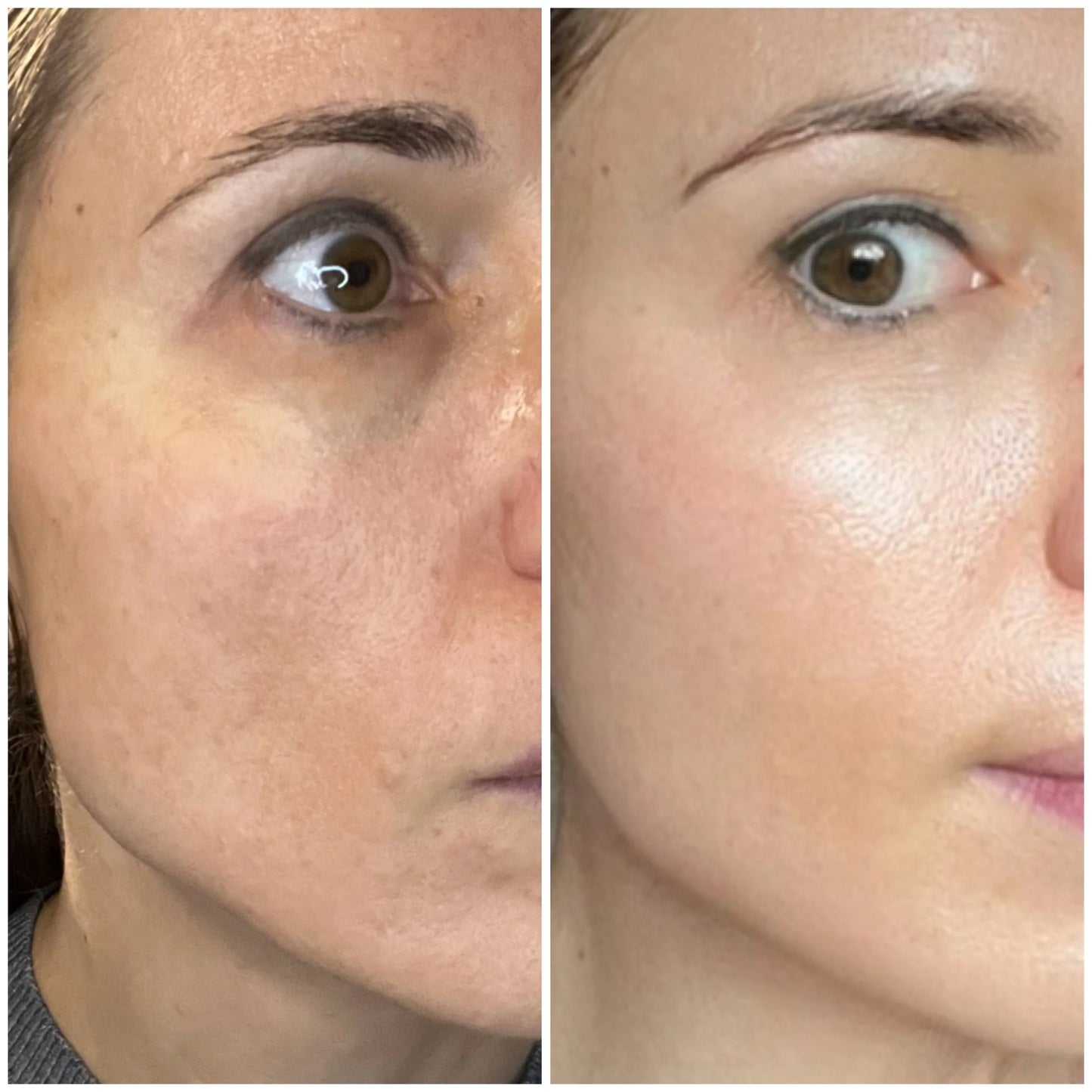 Dermalab Anti-Aging Micro Infusion Treatment 1 single applicatie