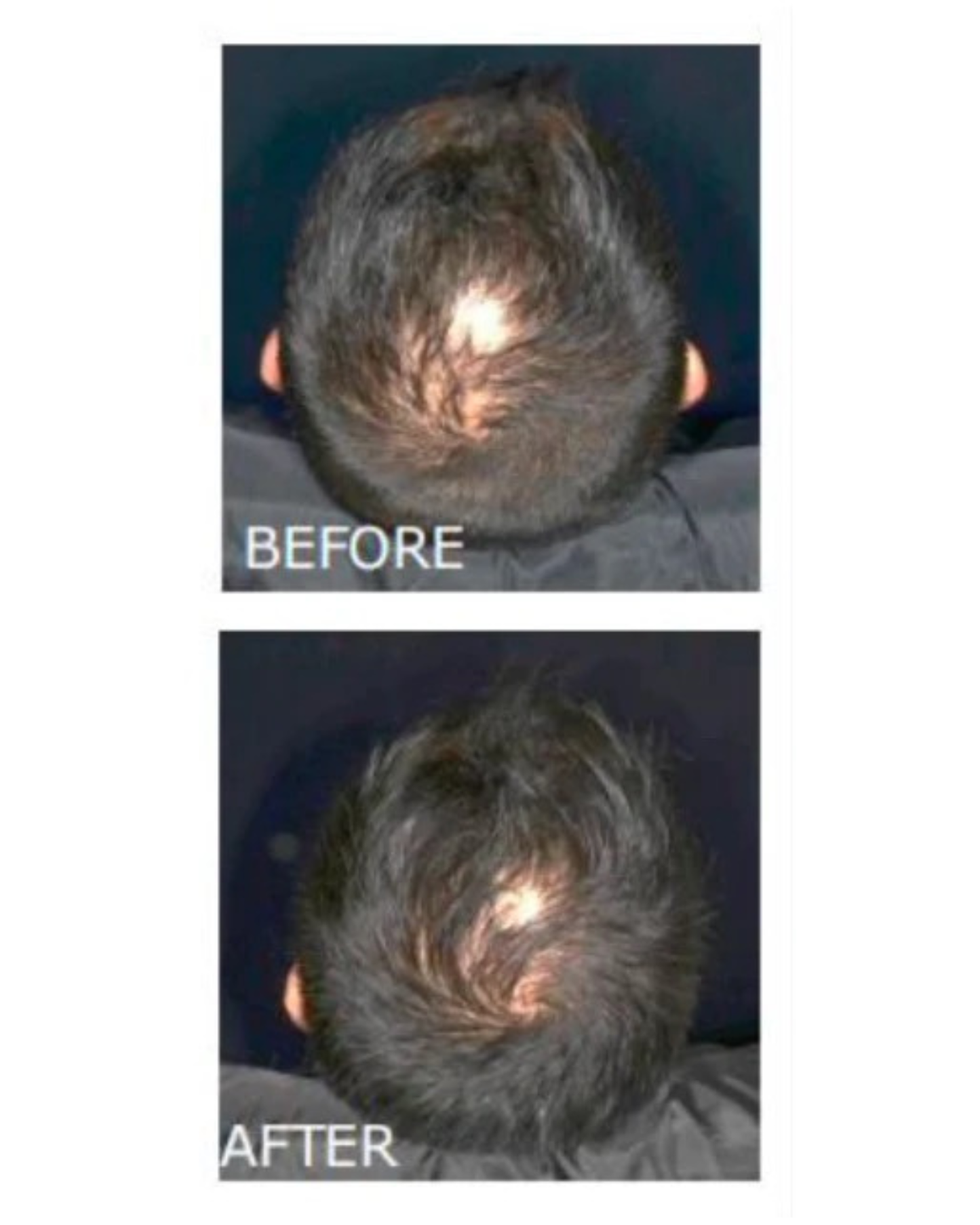 Hair Growth Infusion Dermalab 6 weken plan