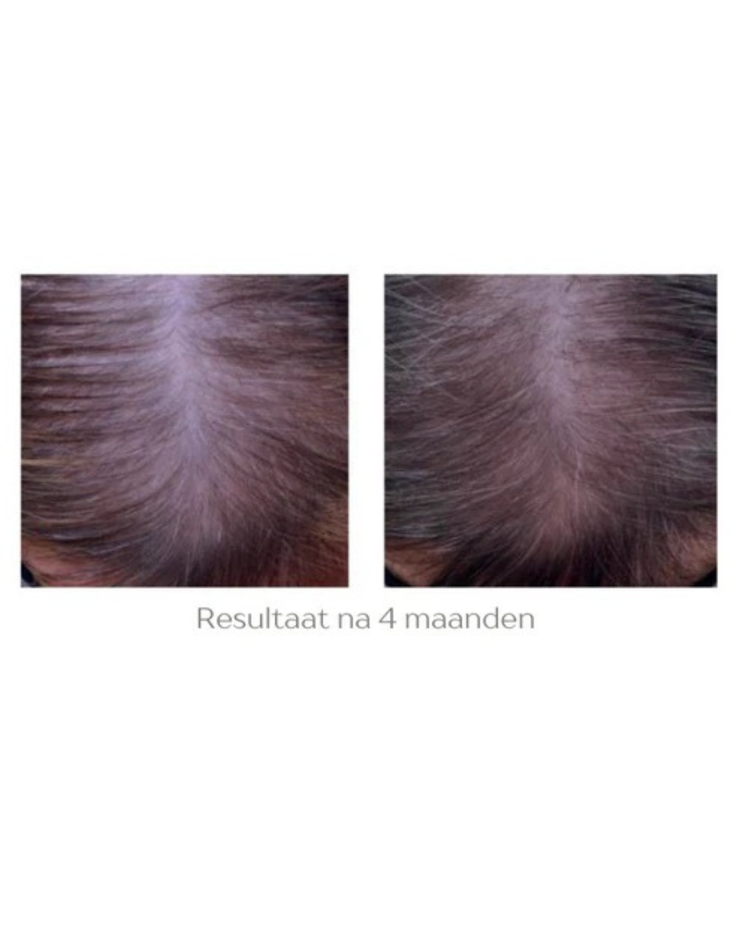 Hair Growth Infusion Dermalab 6 weken plan
